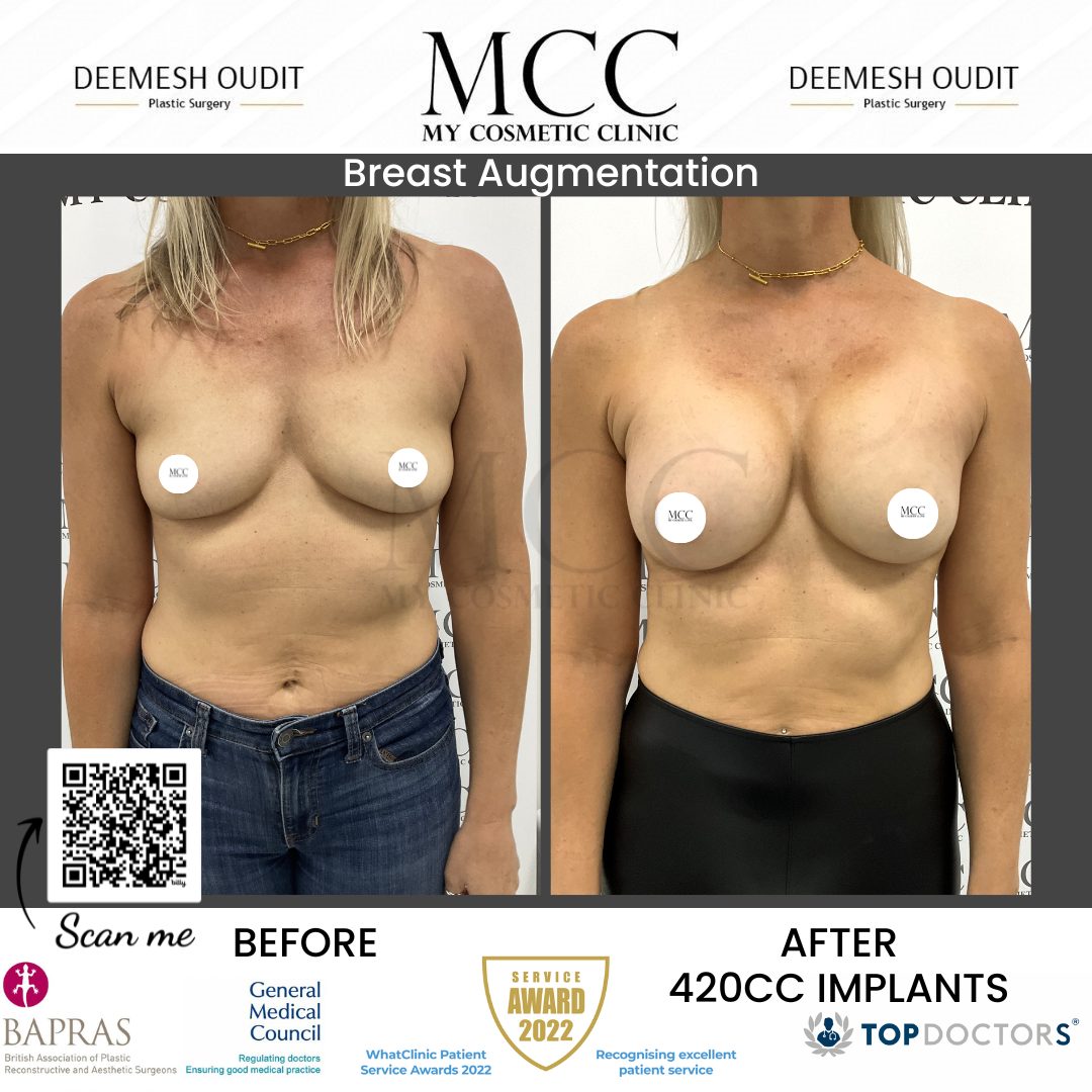 Breast Augmentation 18.08.2023-1 Front