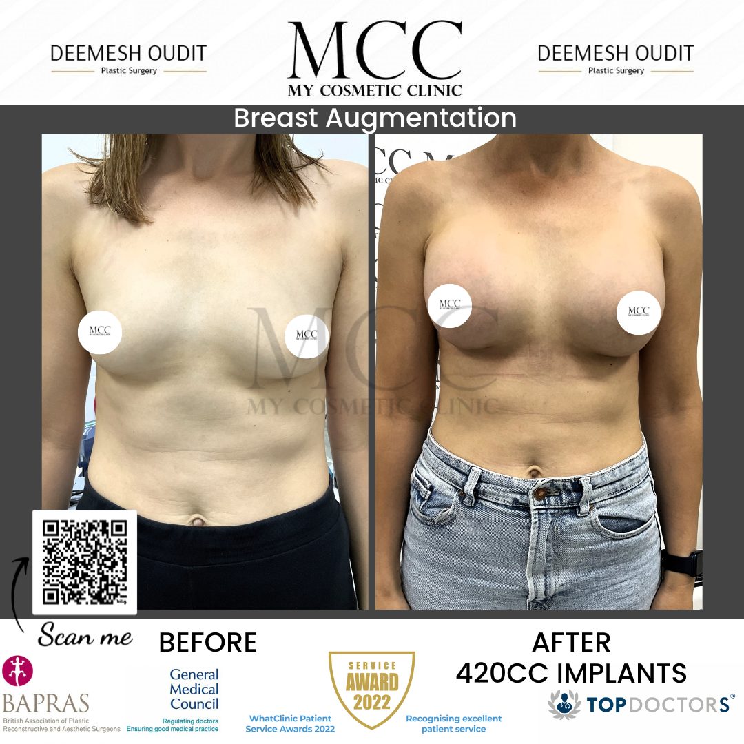 Breast Augmentation 18.08.2023 Front