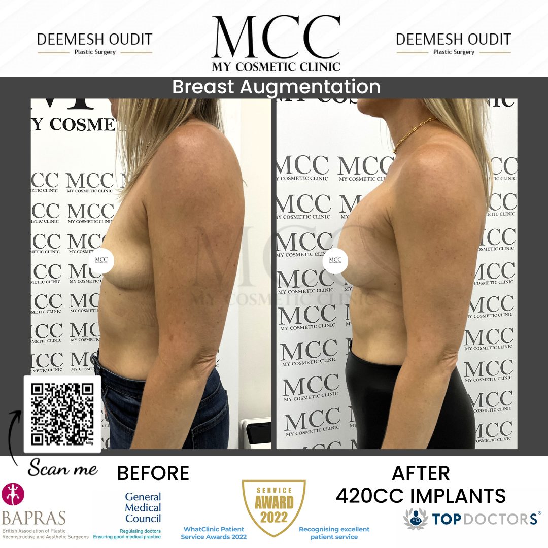 Breast Augmentation 18.08.2023 Side