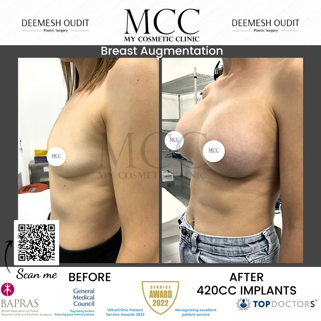 Breast Augmentation 18.08.2023