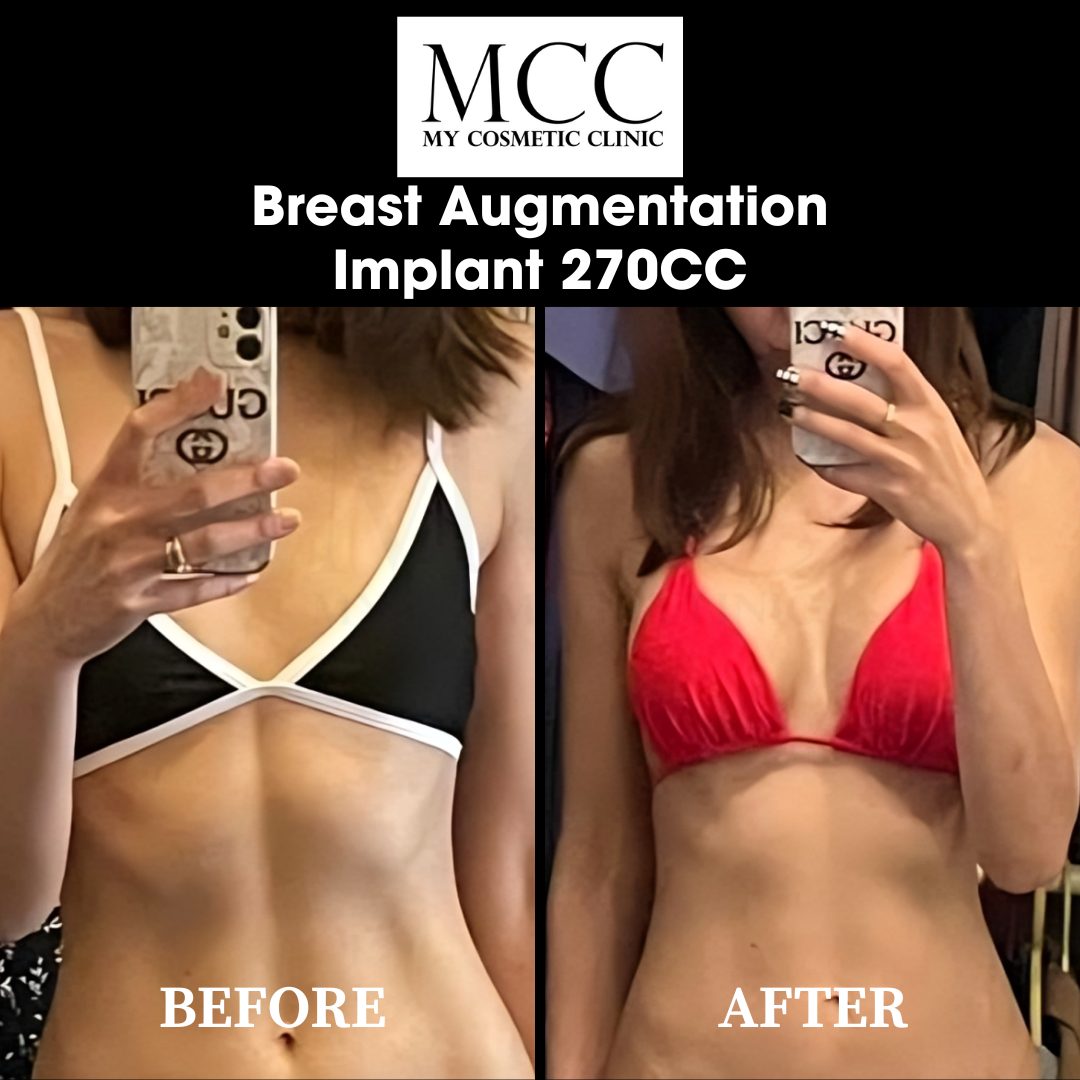 Breast Augmentation 19.02.2024