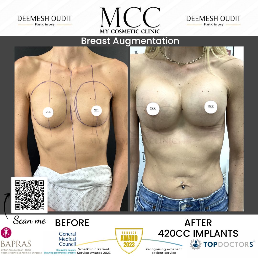 Breast Augmentation 19th Jan 2024