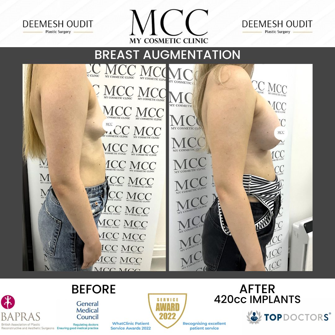 Breast Augmentation 20231025