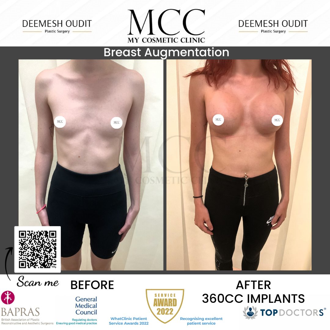 Breast Augmentation 21.08.2023 Front