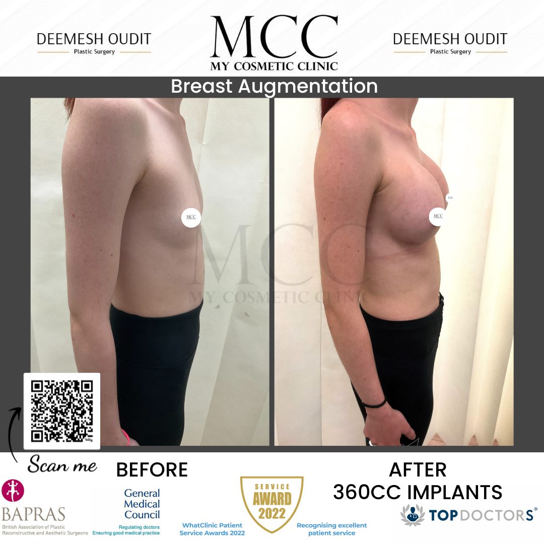 Breast Augmentation 21.08.2023 Side