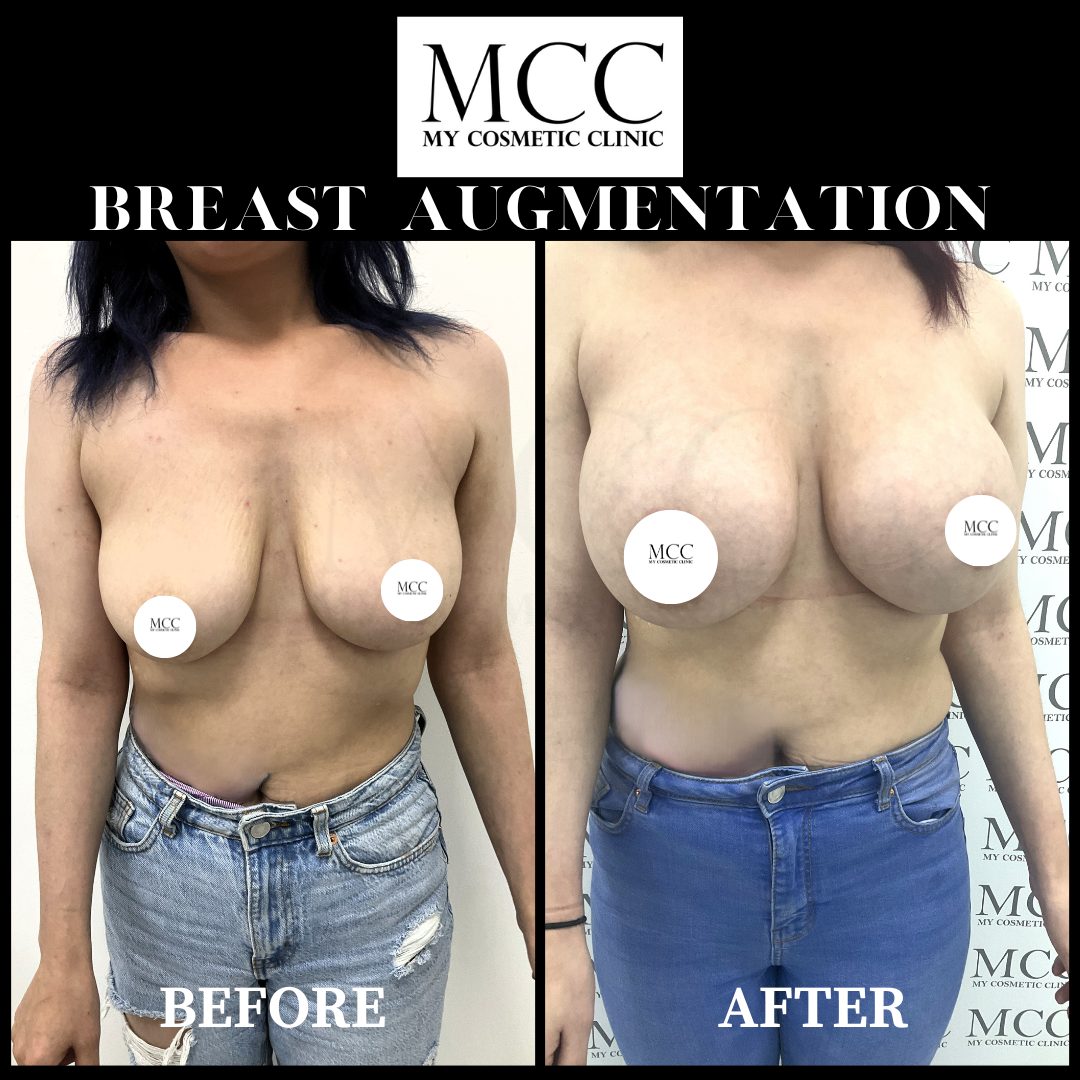 Breast Augmentation 28.10.2022 1