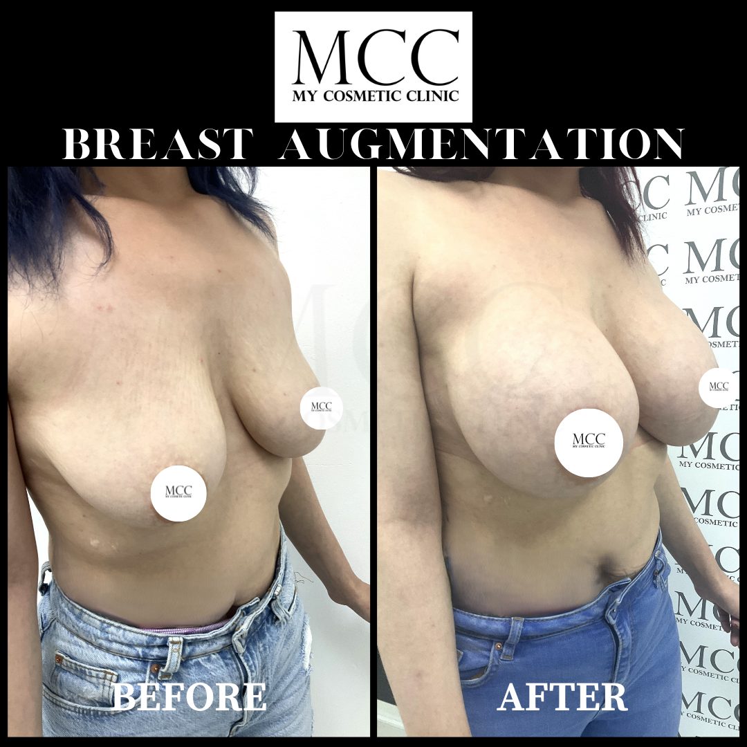 Breast Augmentation 28.10.2022 2