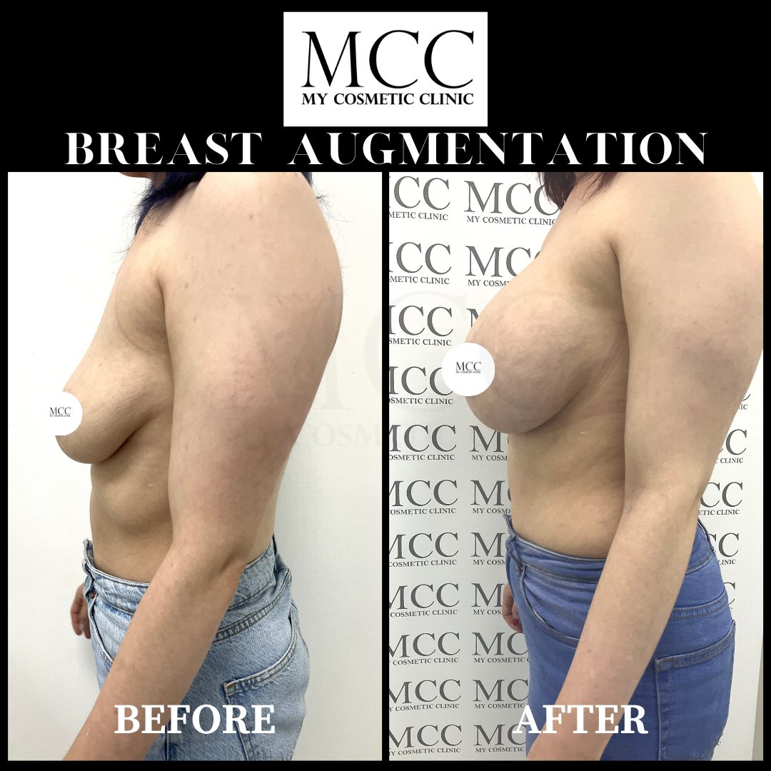 Breast Augmentation 28.10.2022 3
