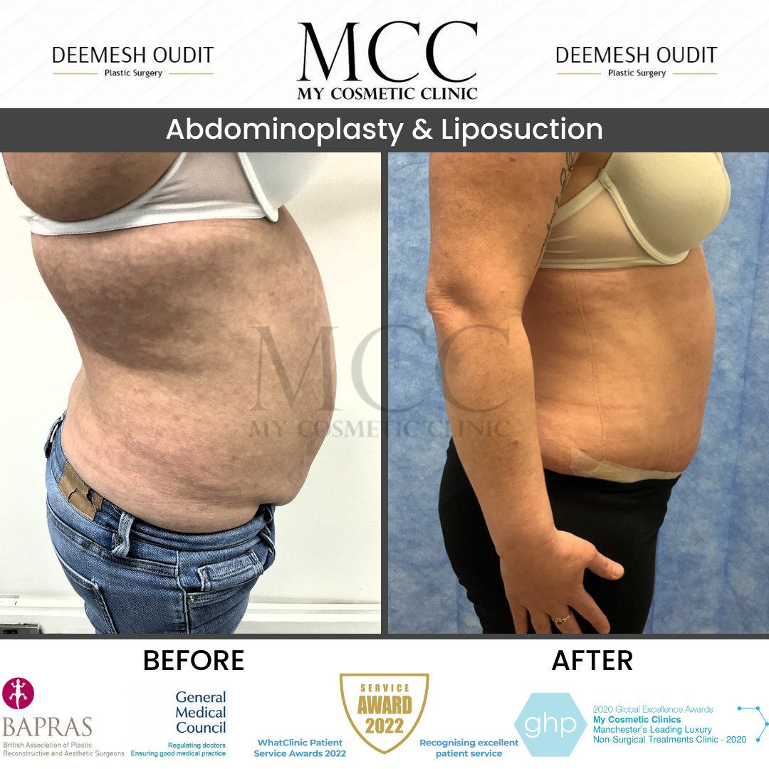 Abdominoplasty & Liposuction 2 31.03.2023