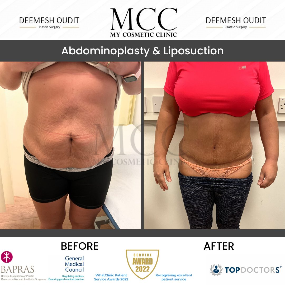 Abdominoplasty & Liposuction 20231110