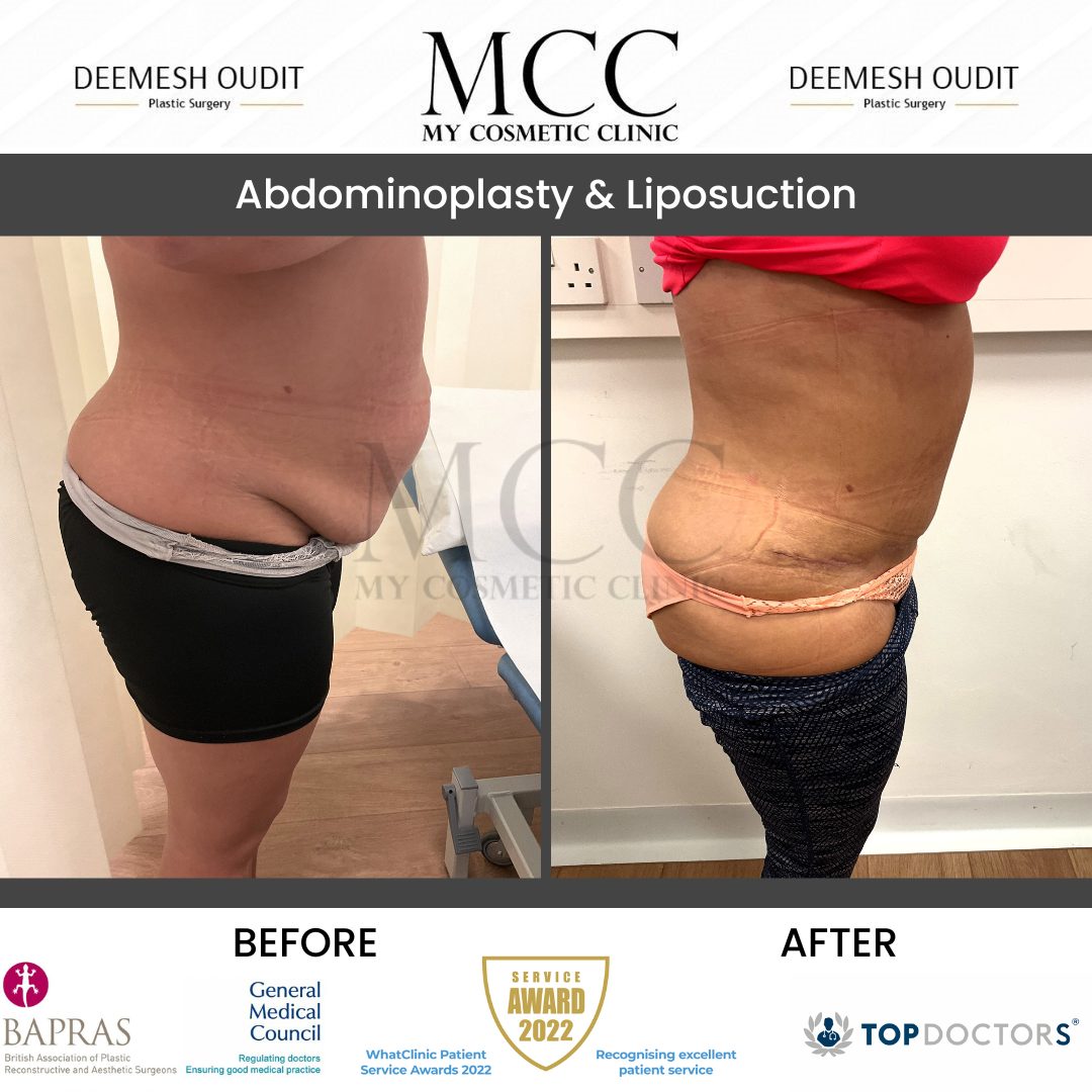 Abdominoplasty & Liposuction Side 20231110