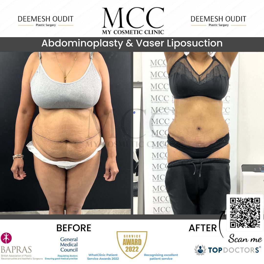 Abdominoplasty & Vaser Liposuction 02.08.2023