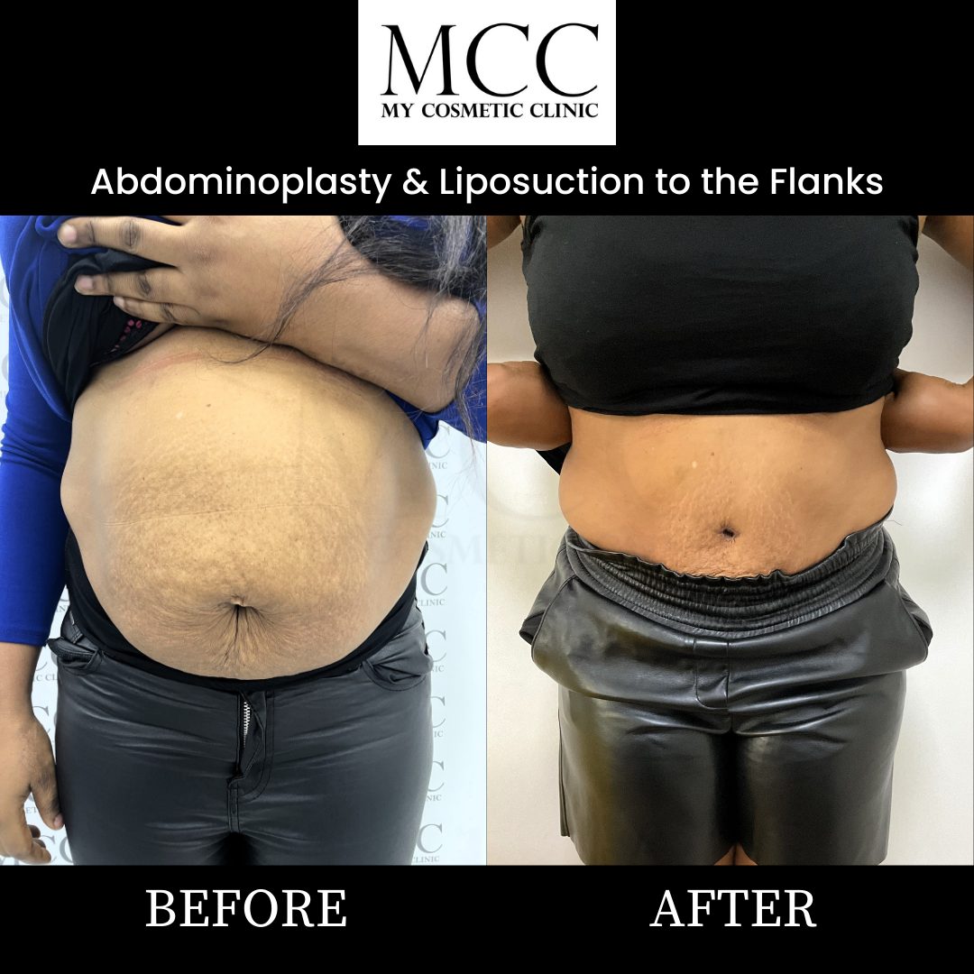 Abdominoplasty and Liposuction 12.02.2022 1
