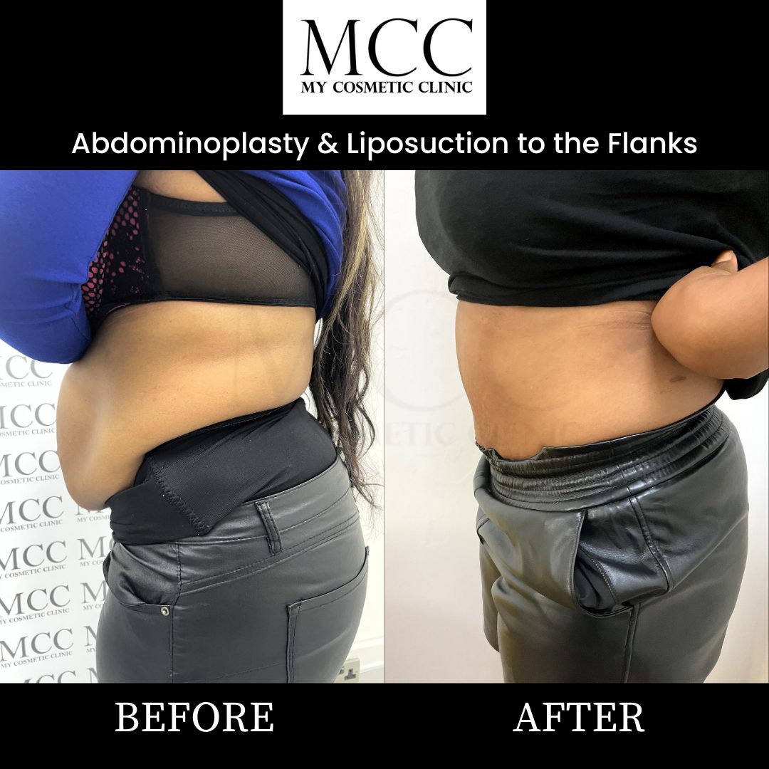 Abdominoplasty and Liposuction 12.02.2022 2