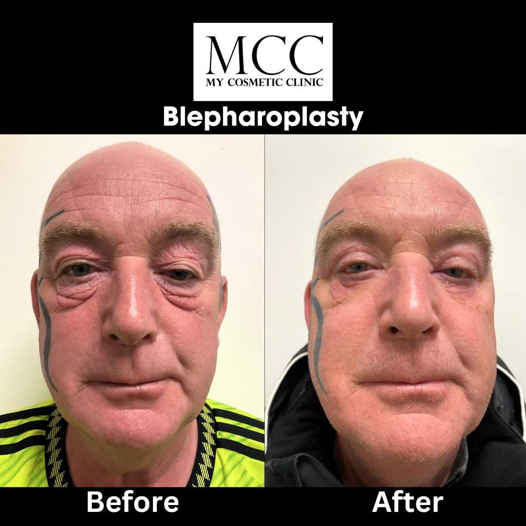 Blepharoplasty 15.12.2022