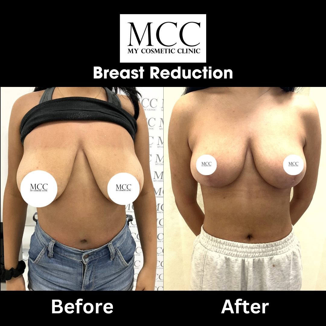 Breast Reduction 11.08.2023