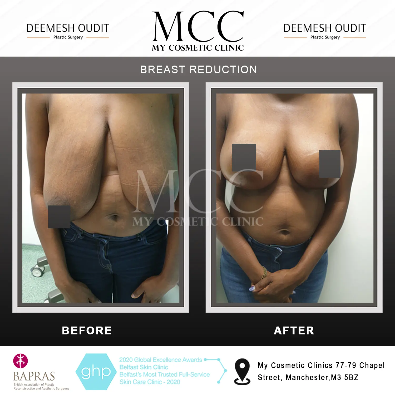 Breast-reduction4.jpg