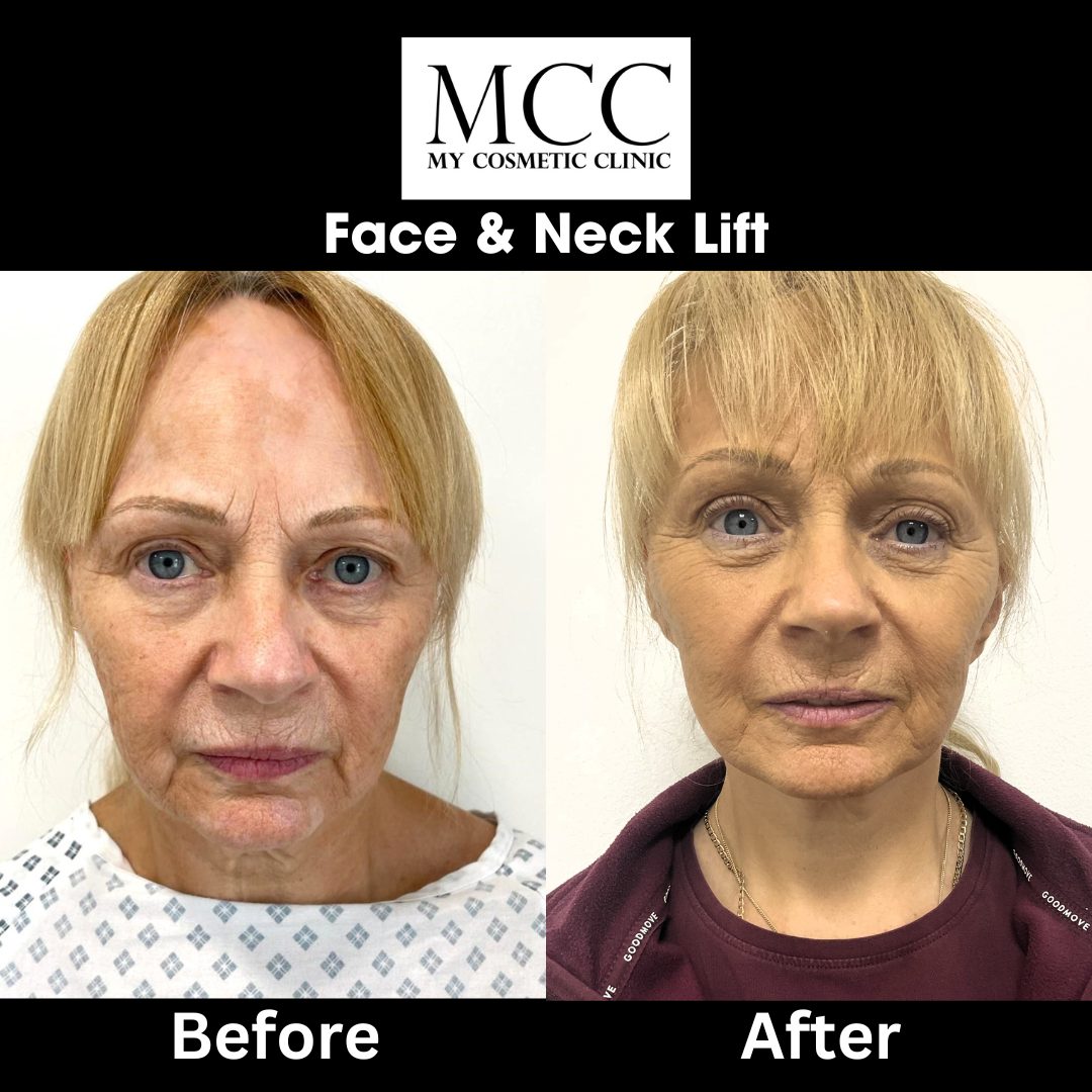 Face & Neck Lift 02.09.2022 1