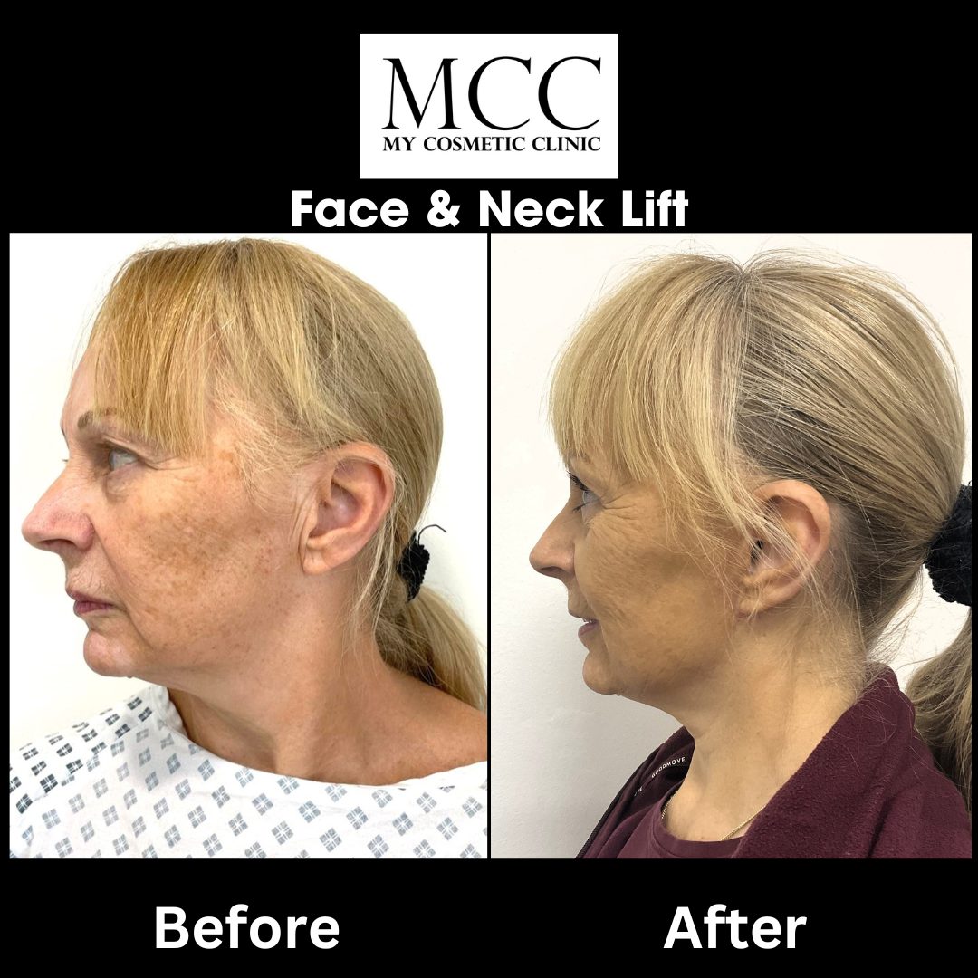 Face & Neck Lift 02.09.2022 2