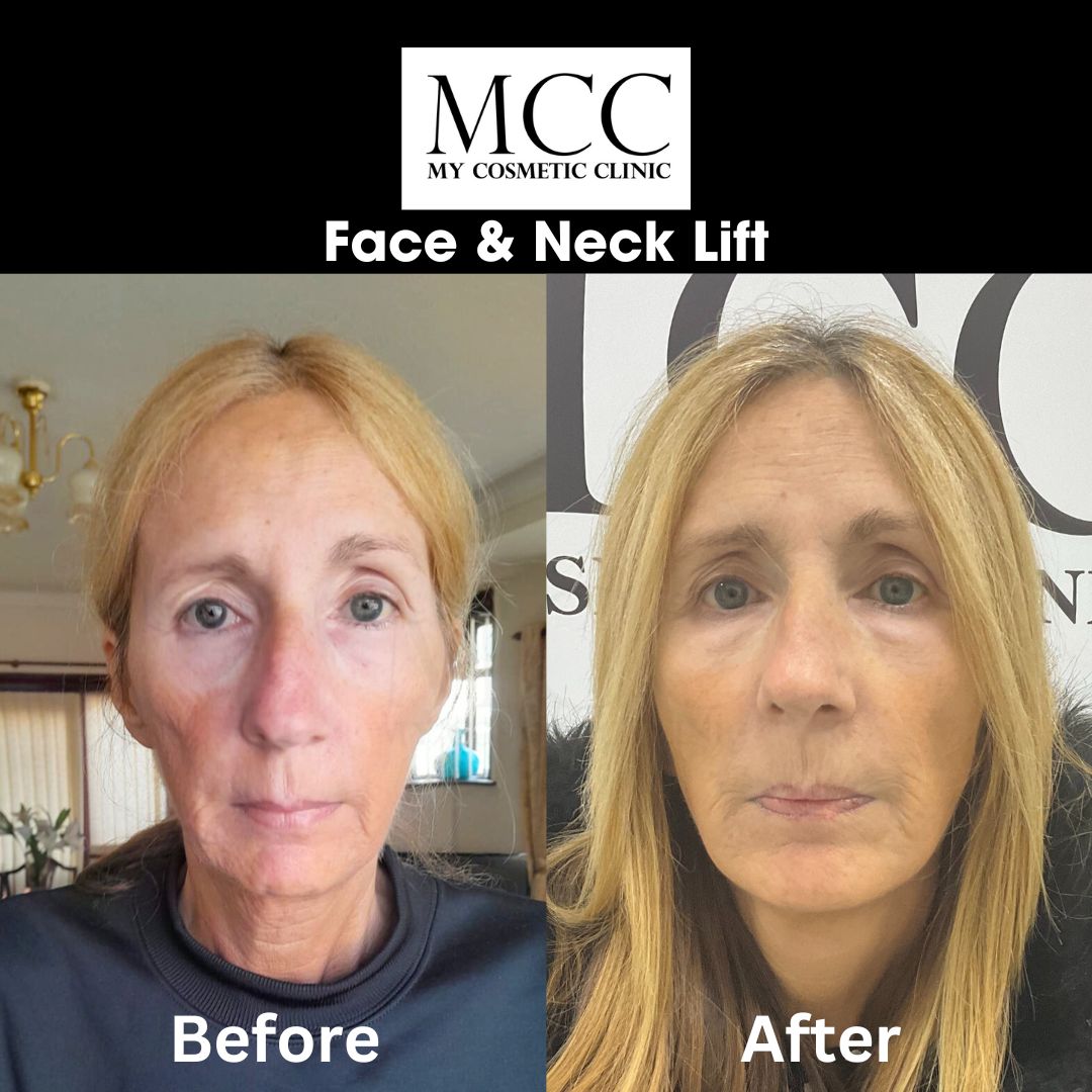 Face & Neck Lift 21.09.2023