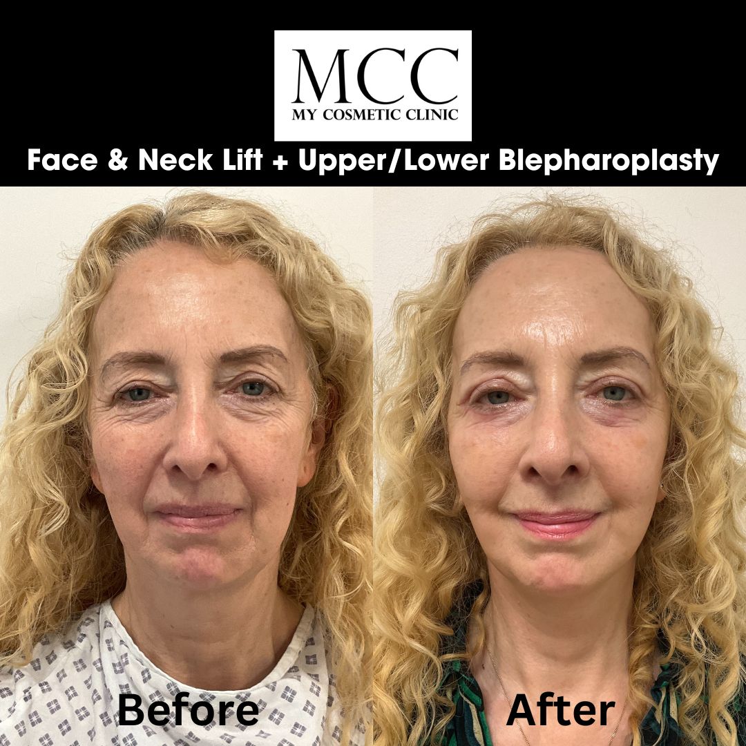 Face & Neck Lift + UpperLower Blepharoplasty 26 Sept 2024 1