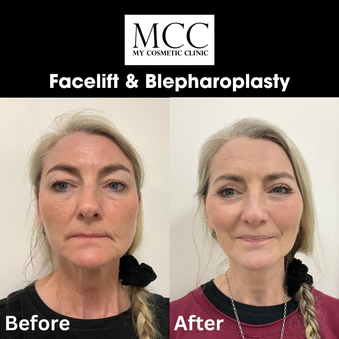 Facelift & Blepharoplasty 22 Nov 2024 1