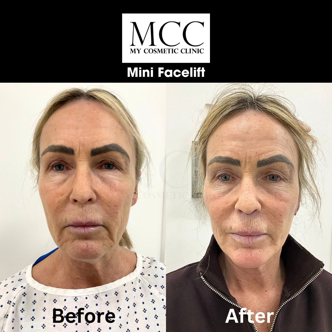 Mini Facelift - Natalie Martin 1