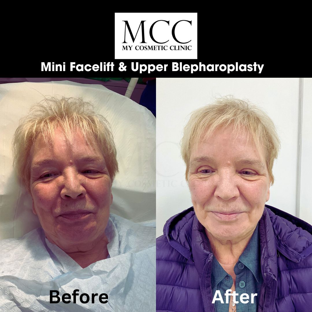 Mini Facelift & Upper Blepharoplasty 29.11.2025 1