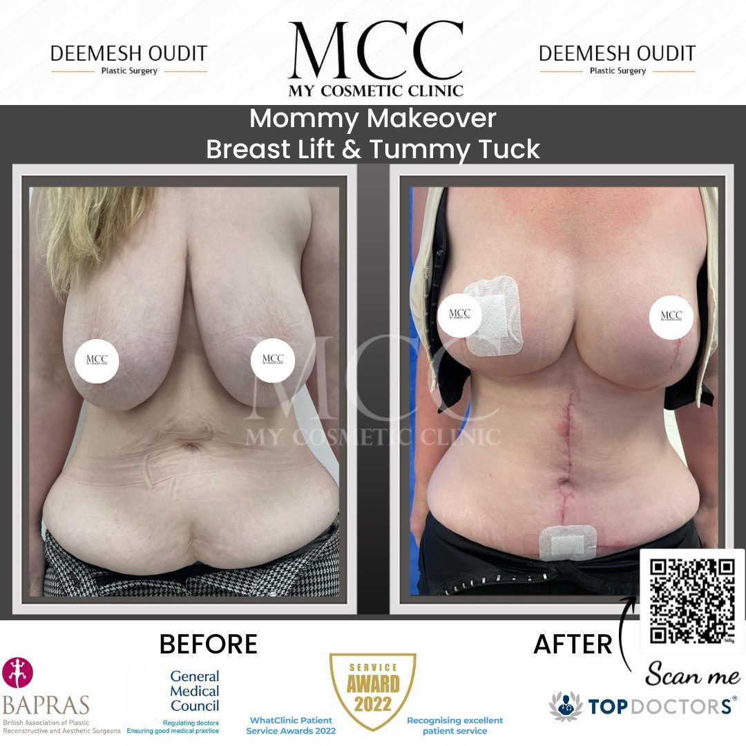 Mommy Makeover 20240110