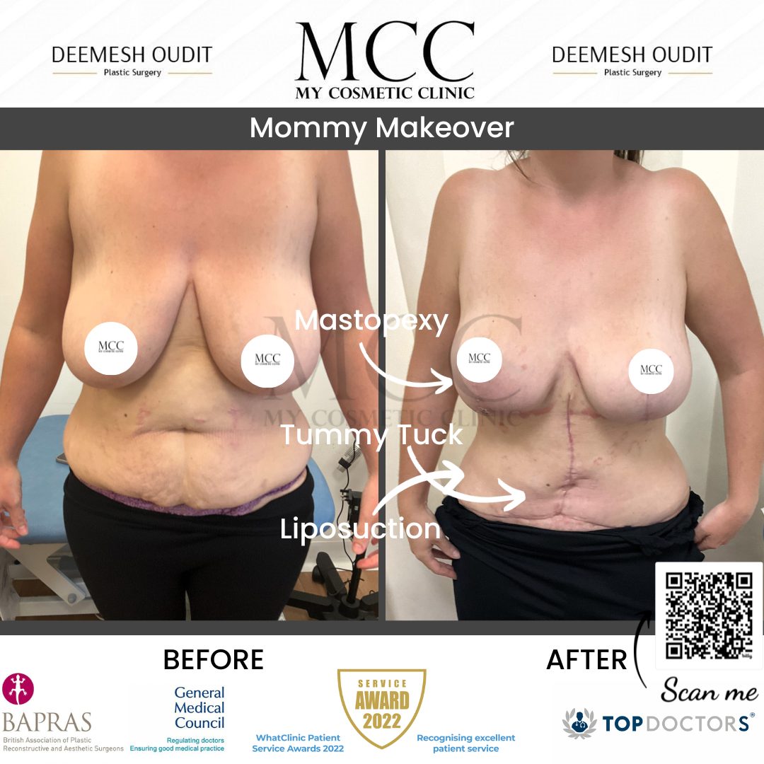 Mommy Makeover 21.07.2023
