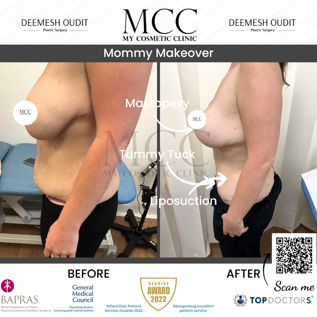 Mommy Makeover Side 21.07.2023